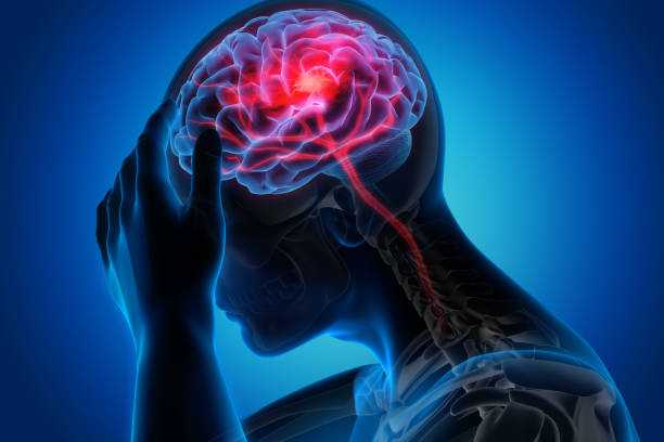 Stroke: The Silent Killer – Causes, Symptoms, Prevention, and Treatment